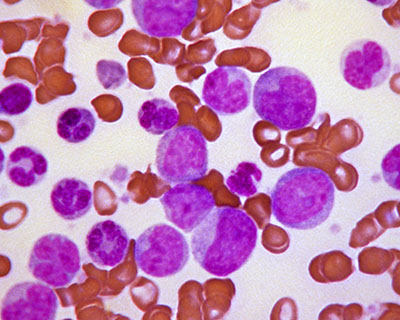 Причины и факторы риска лейкоза (лейкемии, рака крови)